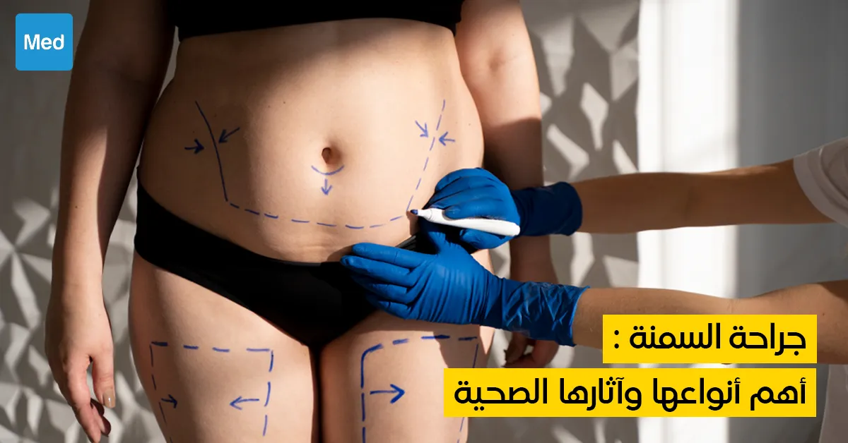 جراحة السمنة : أهم أنواعها وآثارها الصحية